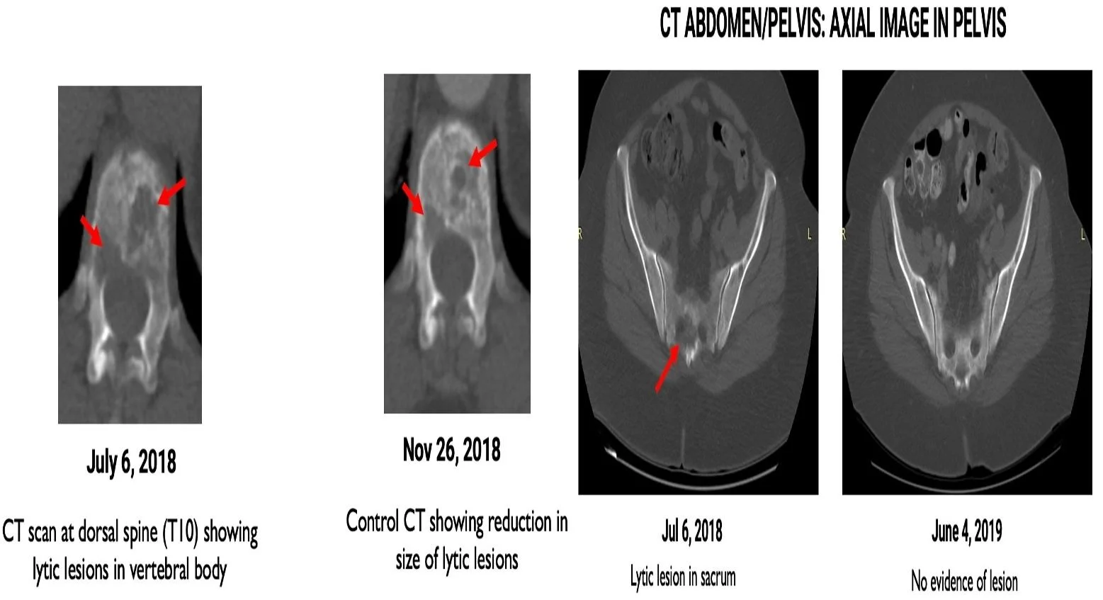 Table 2 CT Results for Case 2 CT scans from July 6, 2018, to June 4, 2019, reveal significant reduction and eventual elimination of lytic lesions in both the do