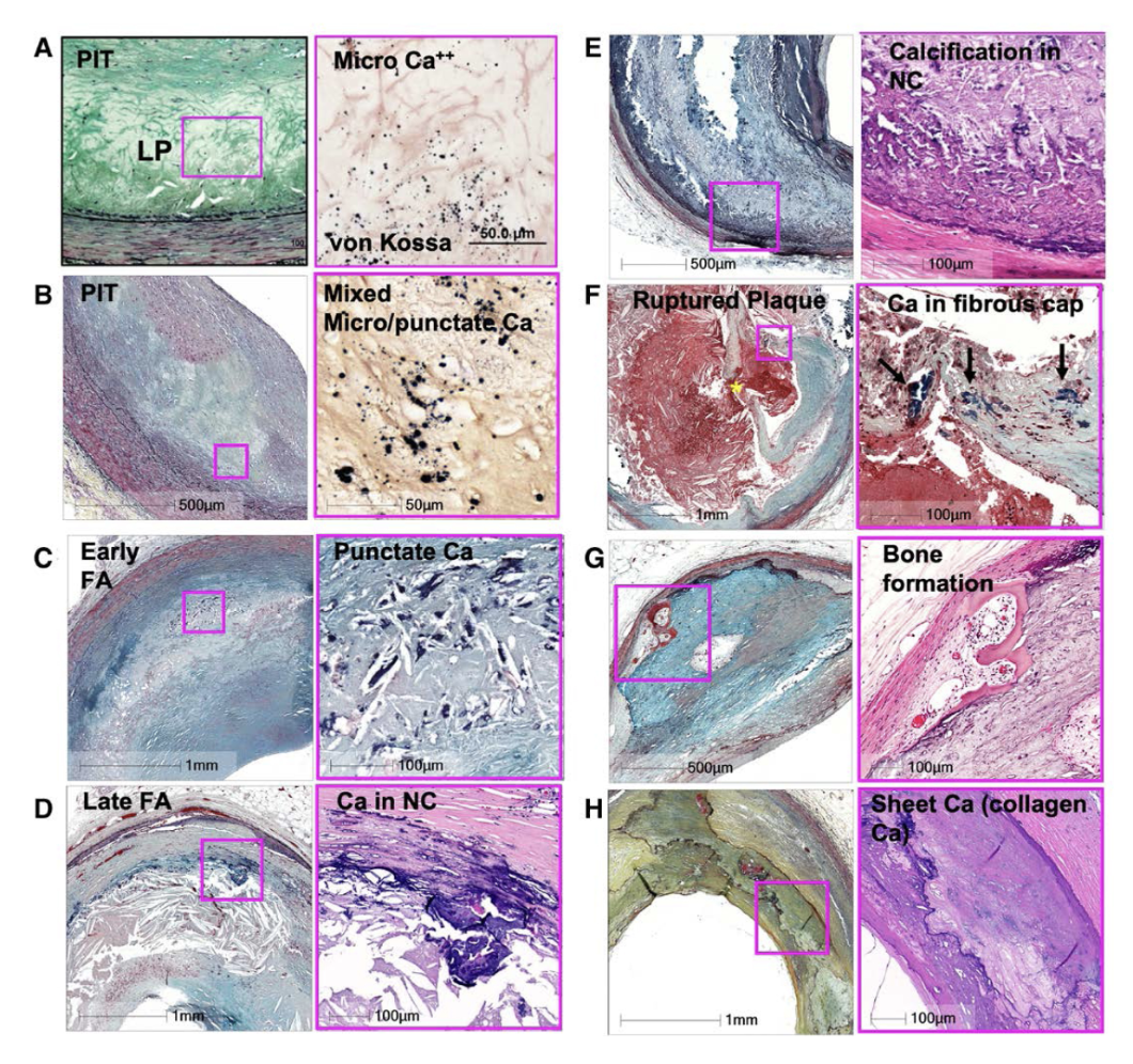 Figure 2. Silent Shifts Beneath the Surface: Patterns of Arterial Calcification