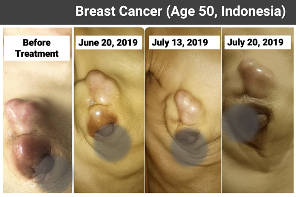 Figure 3: The sequential images show a noticeable reduction in tumor size and improvement in tissue condition throughout the treatment from June 20, 2019, to Ju