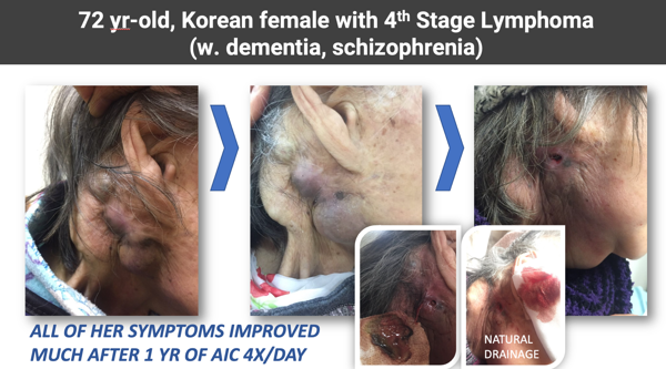 Figure 4: This figure shows a patient experiencing significant improvement with ionic calcium therapy, indicating its potential to enhance treatment outcomes